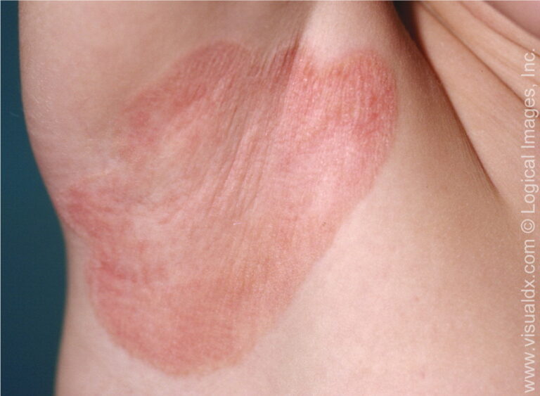 Plaque Psoriasis: The Rash That Didn’t Go Away